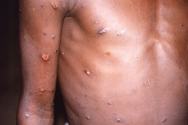 GHS Records 1st Monkeypox Case; 230 Suspected Cases In 88 Districts In Ghana